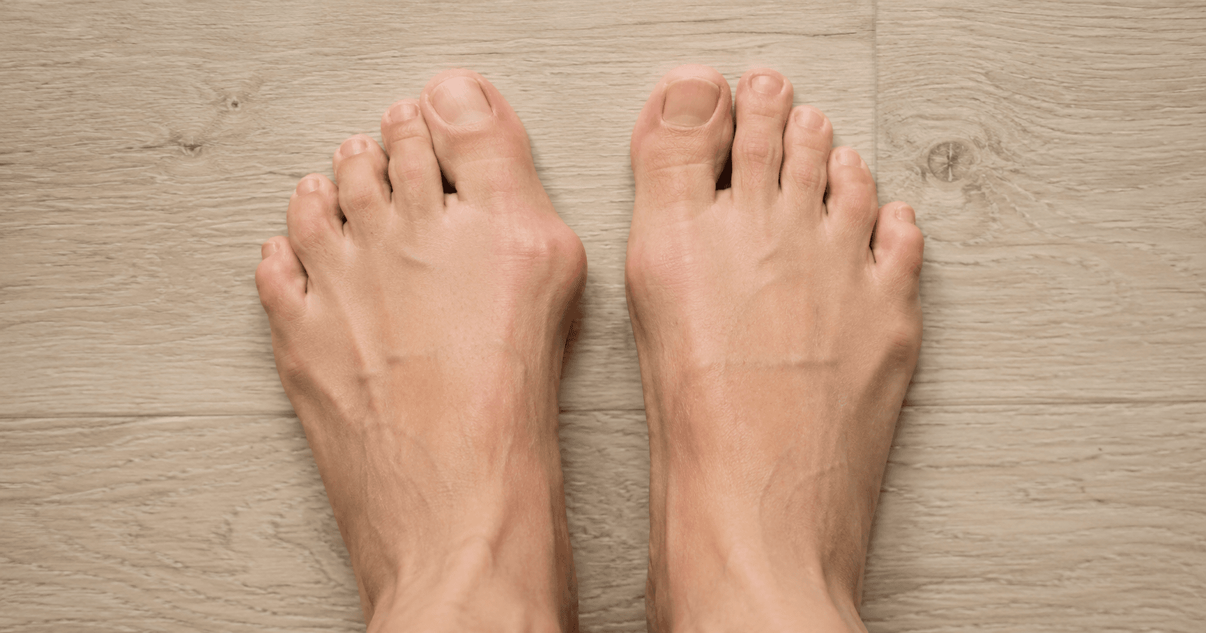 Hallux valgus: Was hinter dem schiefen Großzeh steckt